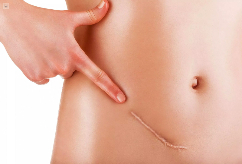 Masaje para cicatrices – Una solución sencilla y eficaz