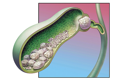 Cirugía vesícula biliar
