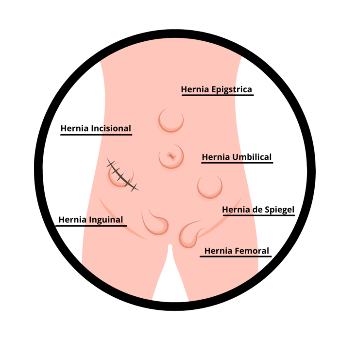 ¿Qué es una Hernia y por Qué Salen?