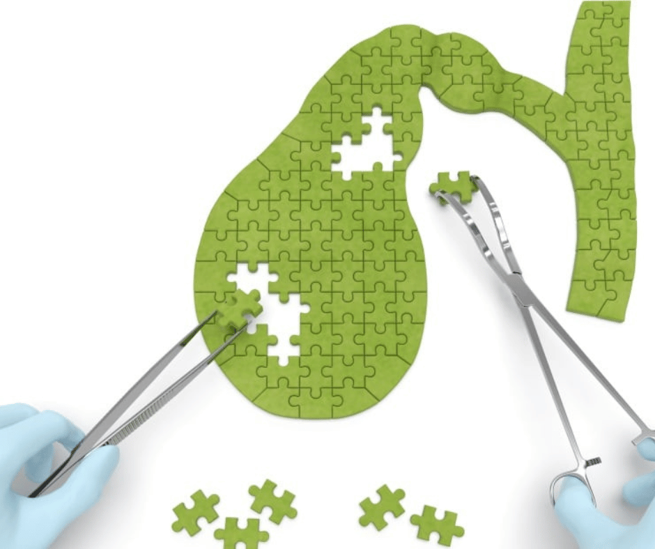 ¿Qué pasa si se tienes piedras en la vesícula?