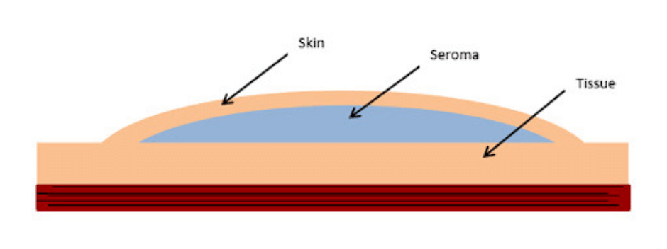 ¿Qué es un seroma?: Comprendiendo esta complicación quirúrgica