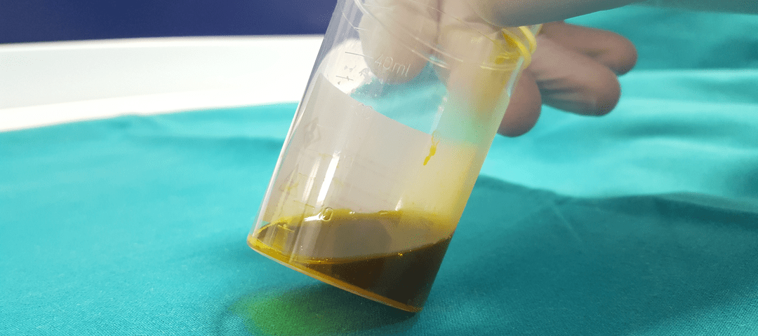 ¿Por qué sale el lodo biliar?